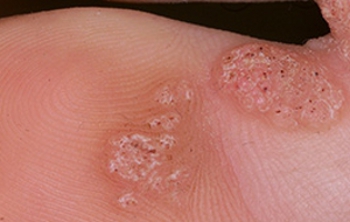 Diagn&oacute;stico de la verruga